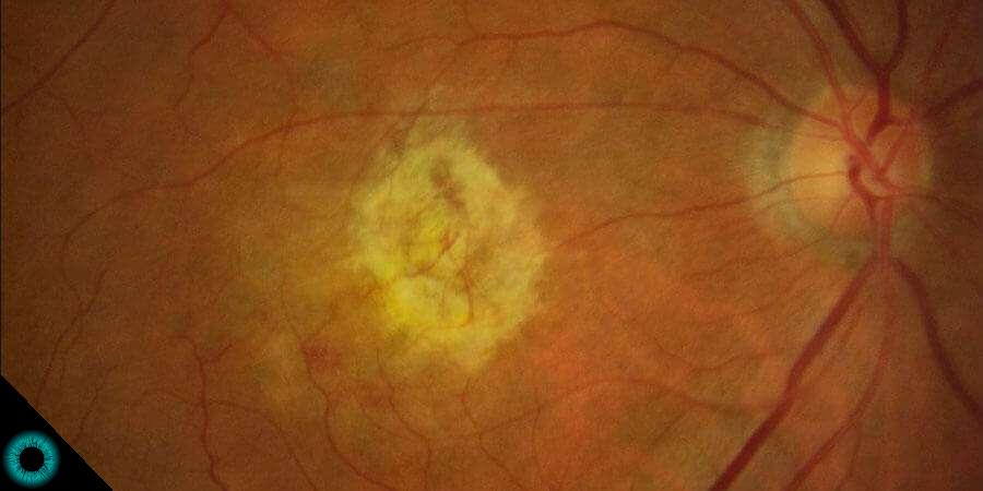 Foto da retina mostrando uma degeneração macular 1