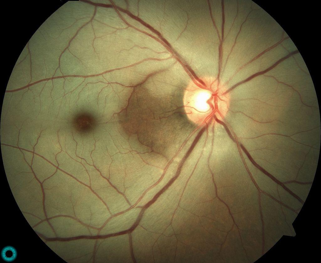 Descubra 8 causas de perda de visão repentina