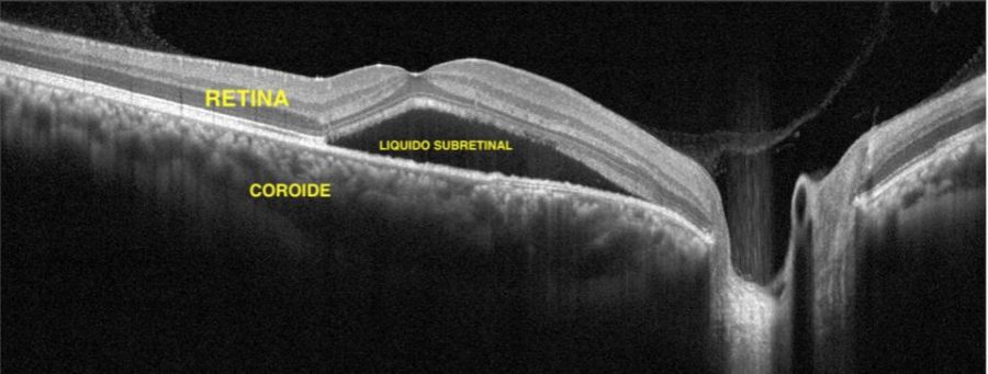 Imagem de uma tomografia (OCT) de retina mostrando a presença de líquido embaixo da retina, característico da doença 