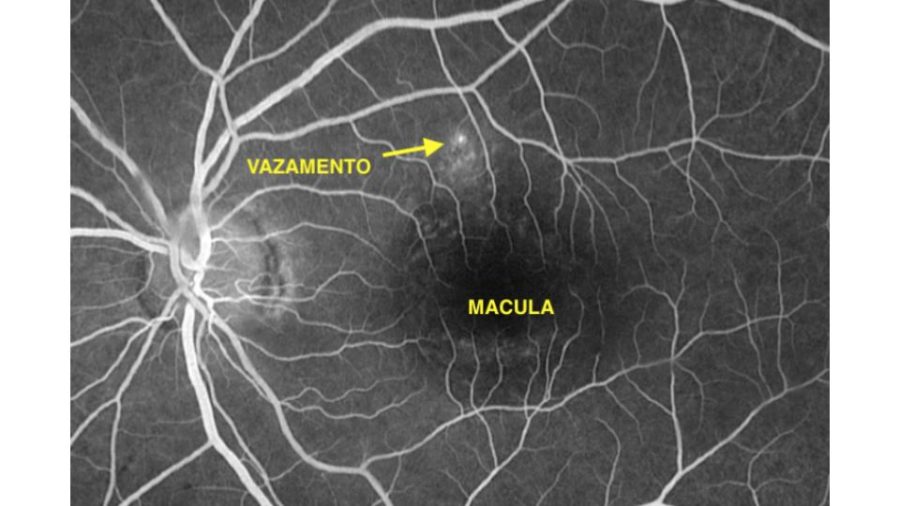 Imagem de um exame de angiofluorescenografia. O corante esta circulando dentro dos vasos da retina. Podemos observar um ponto de vazamento (seta) que corresponde ao local a ser tratado pelo laser.