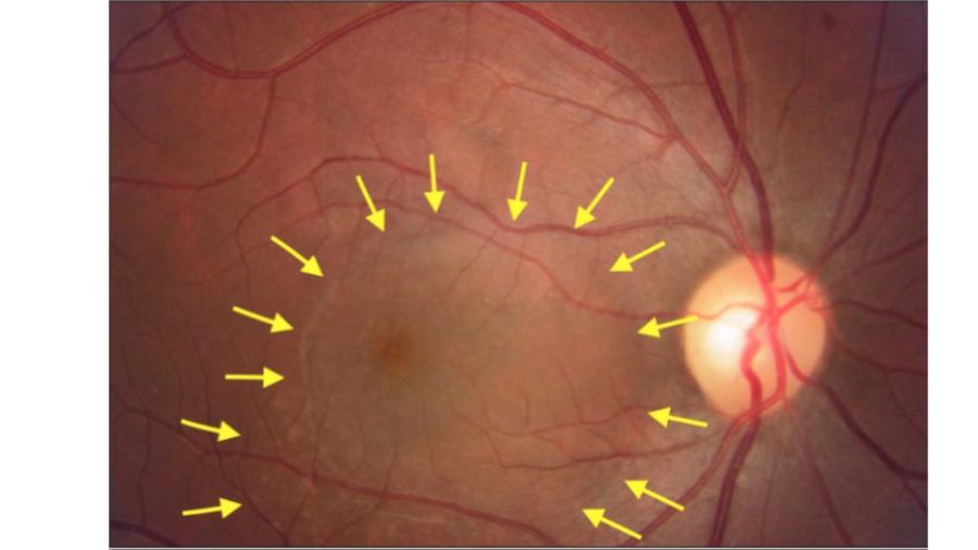 Imagem de um exame de retina, onde podemos delimitar a área com o descolamento da retina pelo acúmulo de líquido embaixo da mesma.