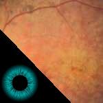 retinose pigmentar