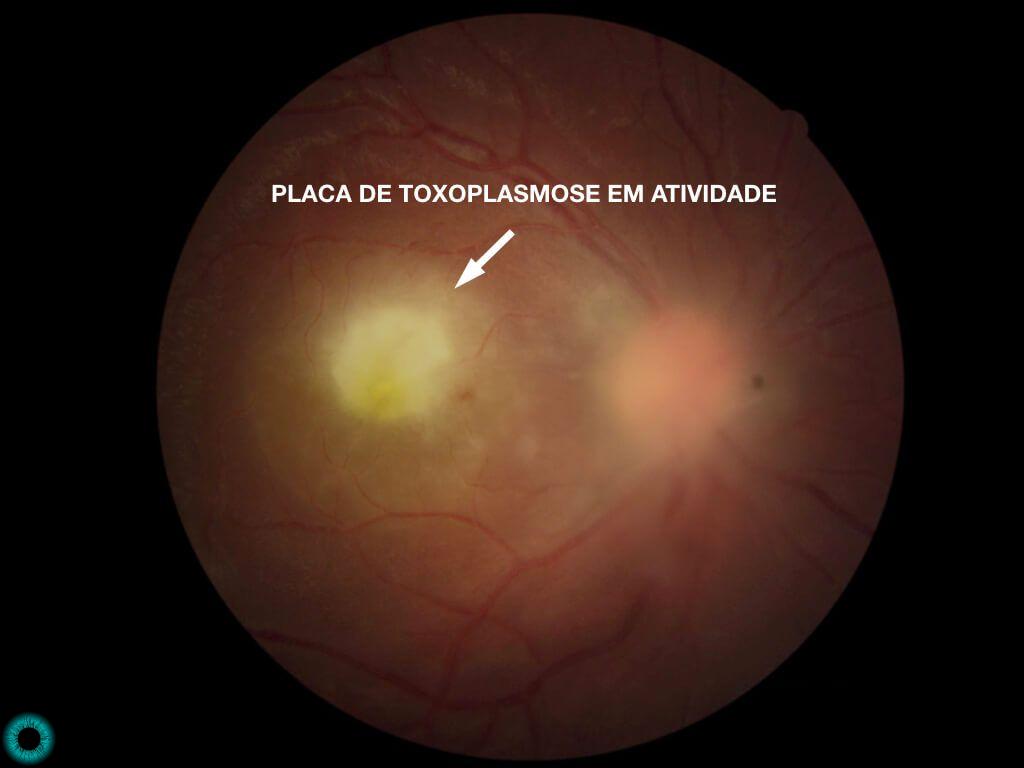 Toxoplasmoza oculara, Toxoplasmoza oculara