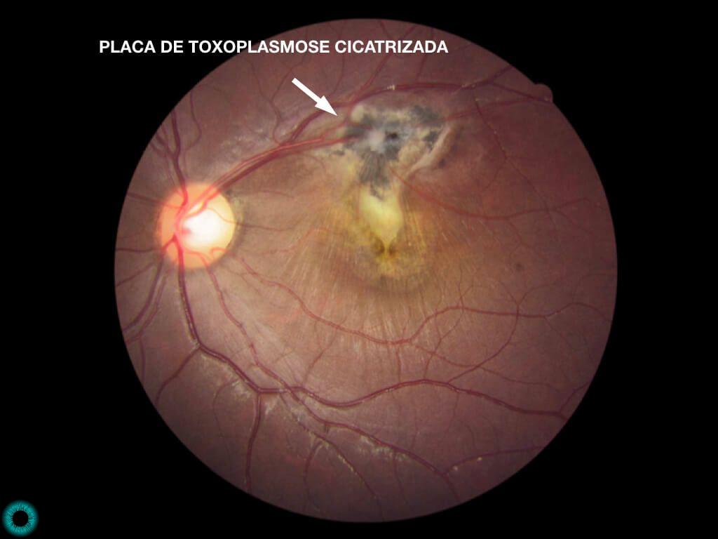 Toxoplasmose ocular: O que é ? Como se contamina? Qual o tratamento?