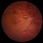 Oclusão de veia da retina, como tratar?