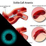 Anemia falciforme pode causar doença na retina?