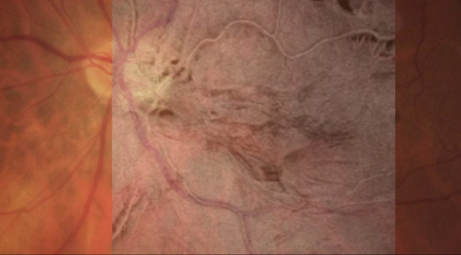 Fotografia do fundo de olho mostrando o enrugamento da retina causado pela membrana epiretiniana.