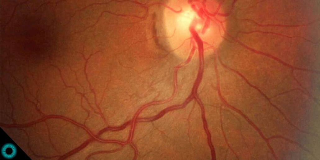 retina hipertenzije)