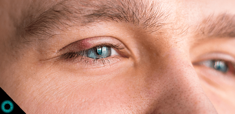 Caroço no olho: 4 causas e como tratar