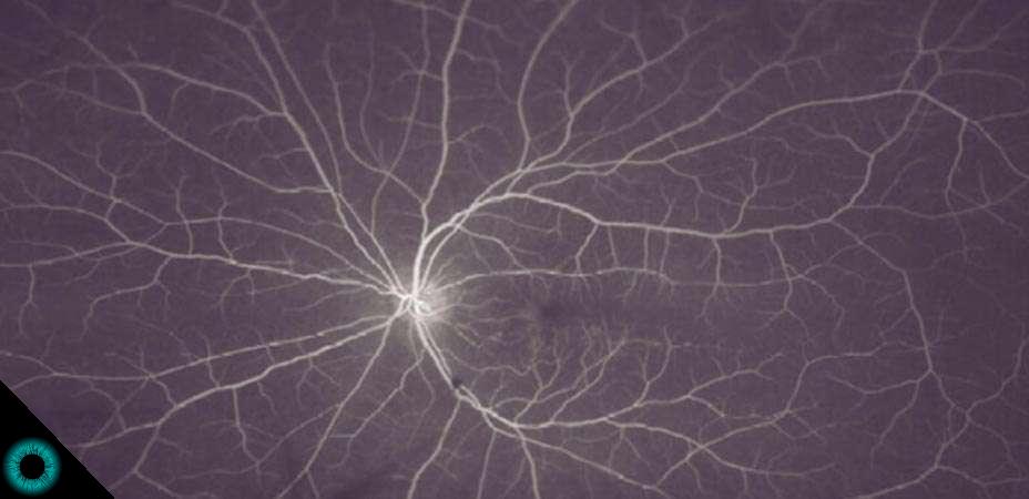 exame de retinografia panoramica