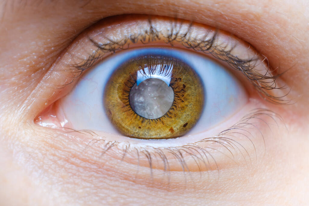 Olho humano com catarata, tratamento por cirurgia de catarata