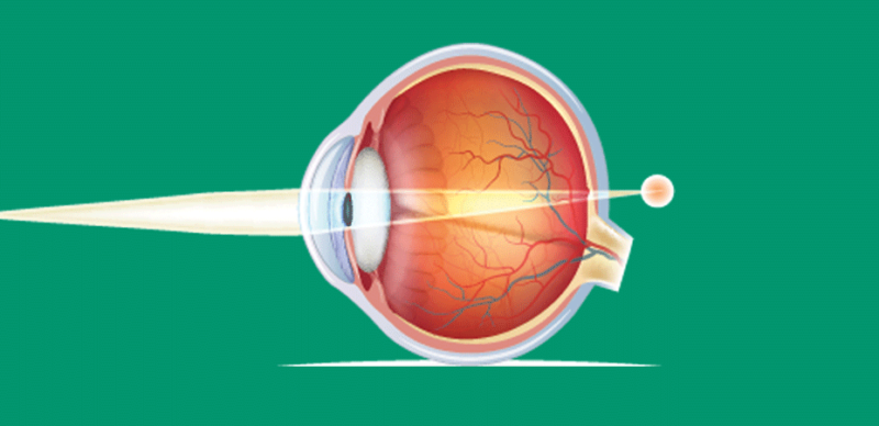 Ilustração demonstrando como a luz se comporta em um olho hipermetropia