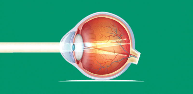 Ilustração demonstrando como a luz se comporta em um olho com astigmatismo