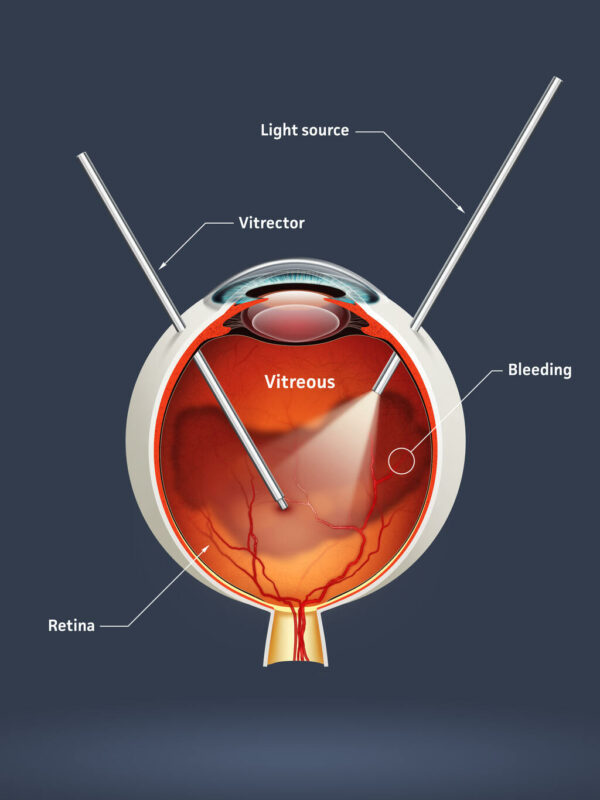 descolamento de retina causa cegueira