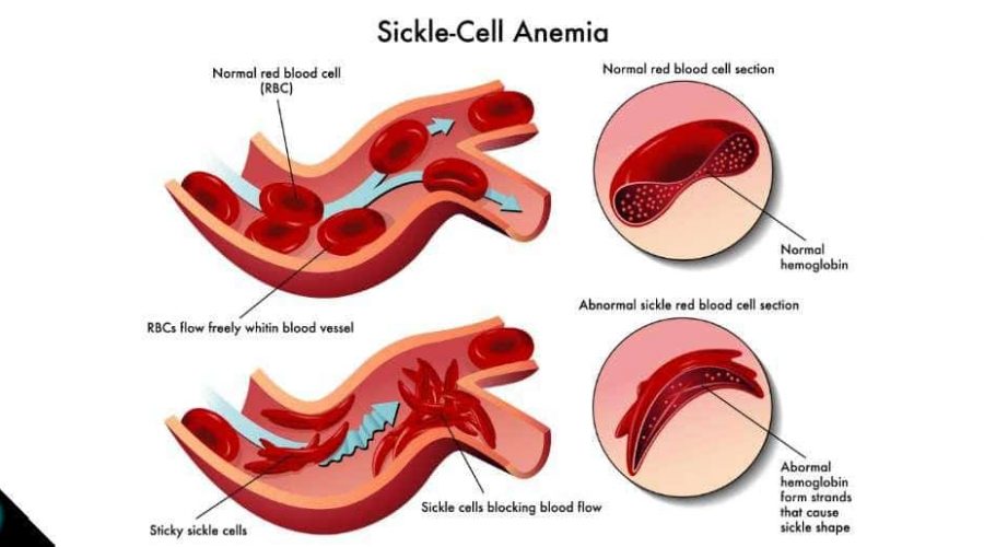 anemia-falciforme-pode-causar-doenca-na-retina