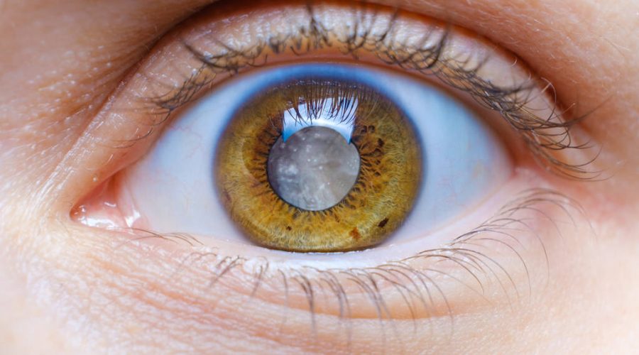 Olho humano com catarata, tratamento por cirurgia de catarata