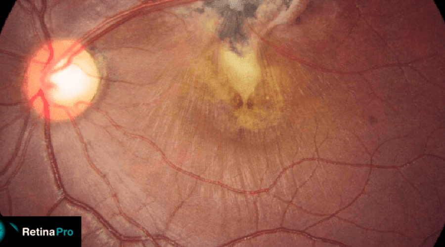 conheca-algumas-doencas-infecciosas-que-afetam-a-retina-1
