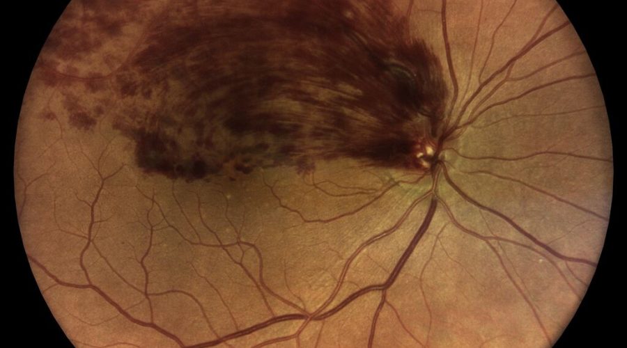 Lesão na retina