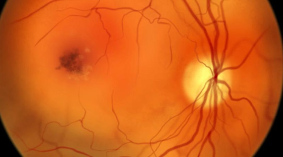 Como a toxoplasmose no olho se manifesta?
