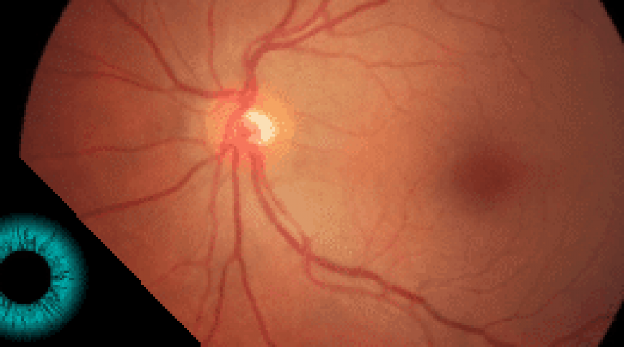 retinografia-colorida-entenda-por-que-fazer-este-exame-oftalmologico-300x145