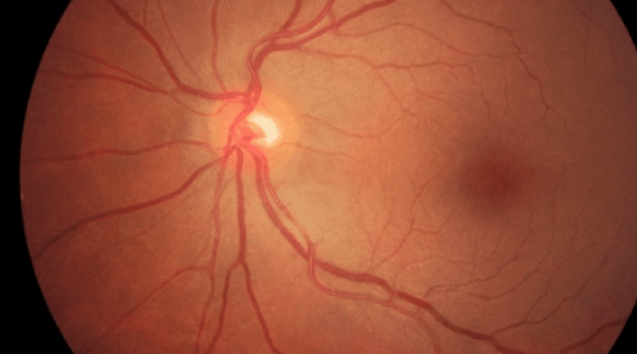 retinografia-colorida-entenda-por-que-fazer-este-exame-oftalmologico retinografia-colorida-entenda-por-que-fazer-este-exame-oftalmologico