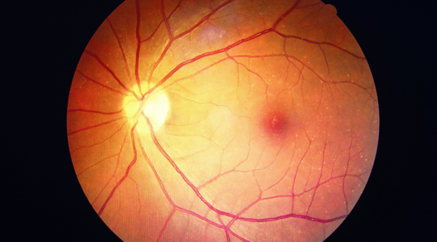 retinose-pigmentar-conheca-as-causas-os-sintomas-e-os-possiveis-tratamentos