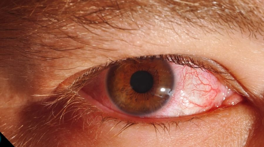 sifilis-ocular-problema-retina