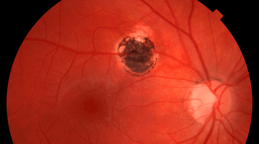 Infográfico: Toxoplasmose Ocular