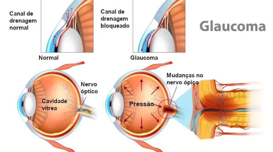 Estrutura detalhada do olho saudável

Glaucoma - Alta pressão danifica o nervo óptico
Canal de drenagem bloqueado - quando muito líquido permanece no olho isso aumenta a pressão