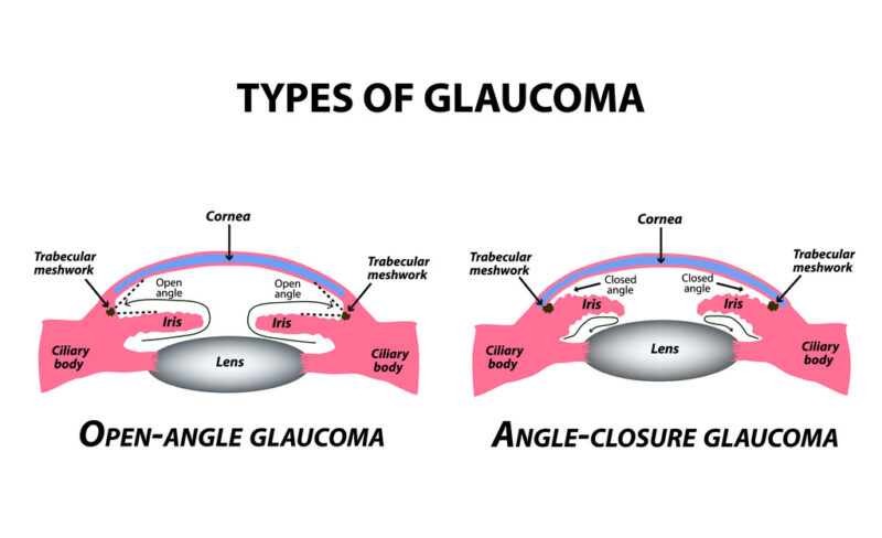 glaucoma cega em quanto tempo