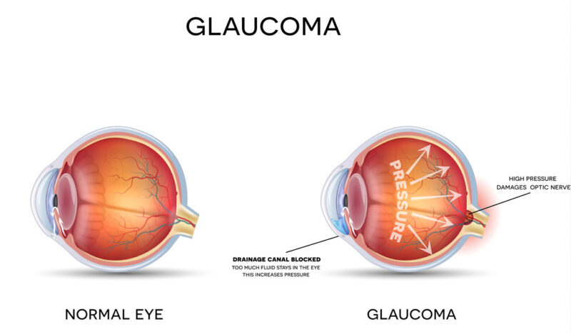 glaucoma é grave