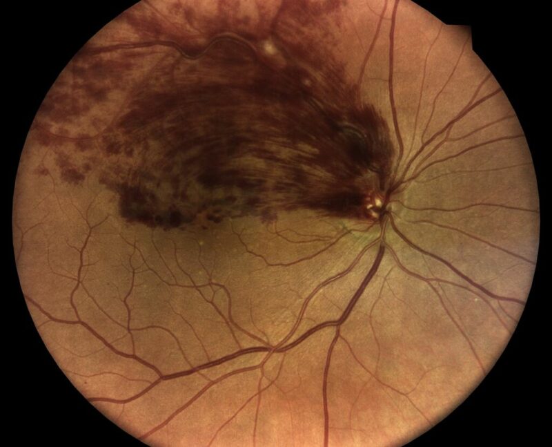 Lesão na retina