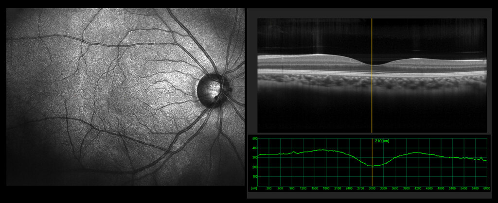 Lesão na retina sintomas