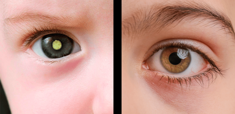 Retinoblastoma: conheça o tumor ocular mais comum em crianças!