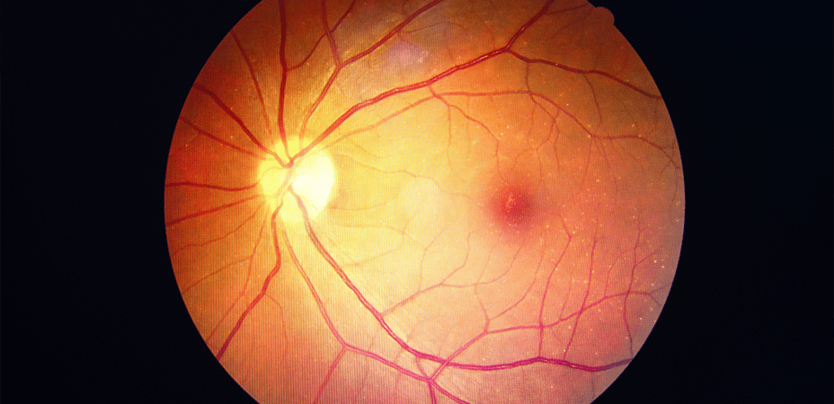 retinose