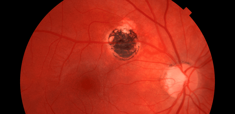 Infográfico: Toxoplasmose Ocular